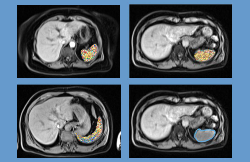 Four abdominal MRI scans highlighting spleen imaging features identified by machine learning